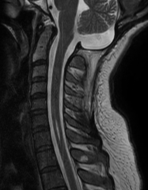 MRI scan, chiari with syringomyelia, after surgery. CSF flow has been restored. Syrinx has collapsed.