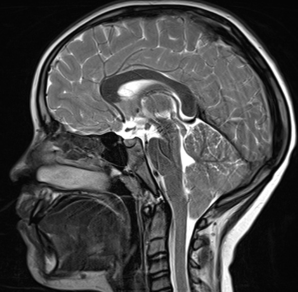 MRI scan, chiari malformation, before surgery. Cerebellar tonsils are herniated through the foramen magnum.